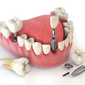 ایمپیلنت و جراحی