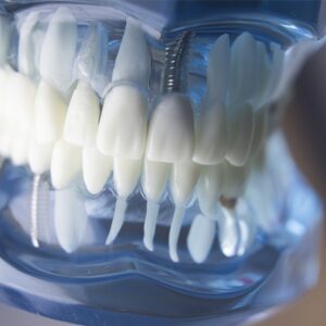 ابزار ایمپلنت دندانی