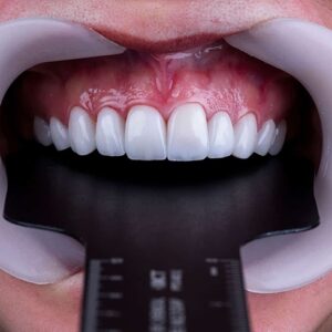 ابزار دنتال فتوگرافی