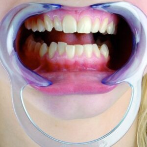 رترکتور دهان