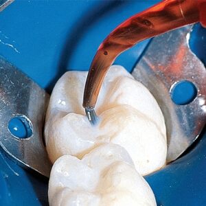 فیشور سیلانت